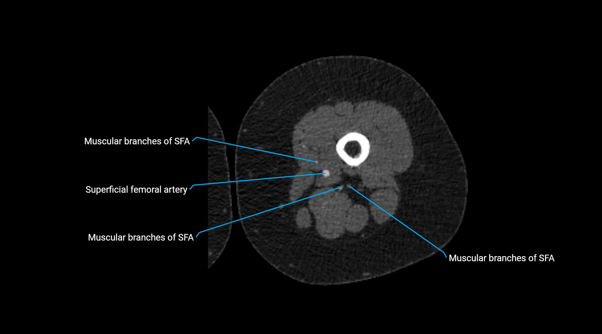 CTA lower limb cross sectional anatomy labelled image _138.webp